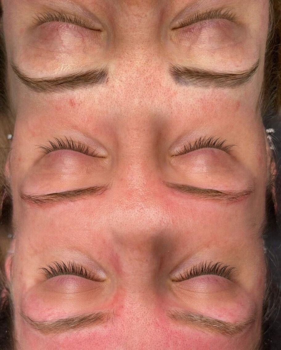 Vorher und Nachher: Reduktion von bräunlichem Microblading